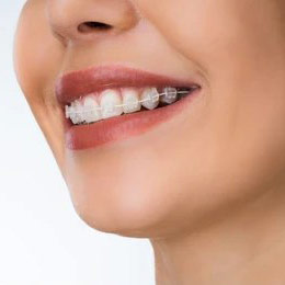 Ceramic Braces